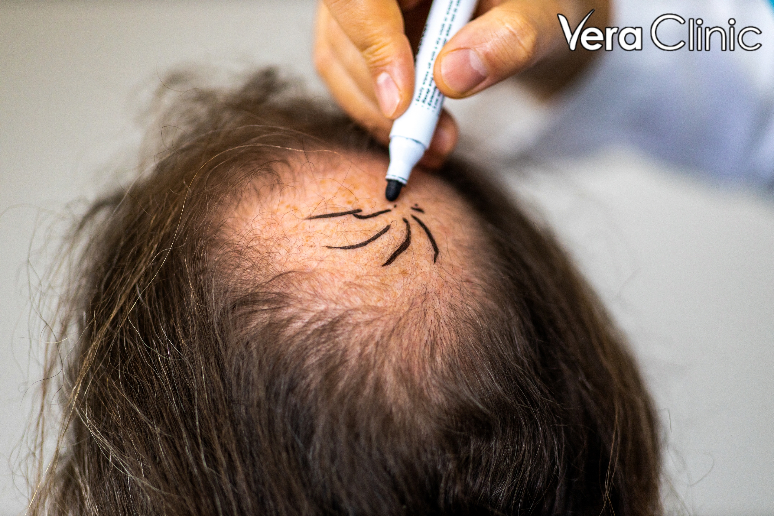 turkish hair transplant